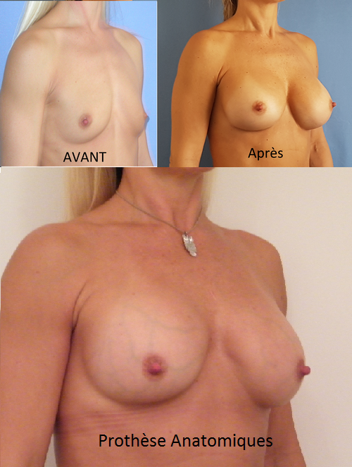 Remplacement des implants (prothèses) mammaires ronds par des implants (prothèses) anatomiques