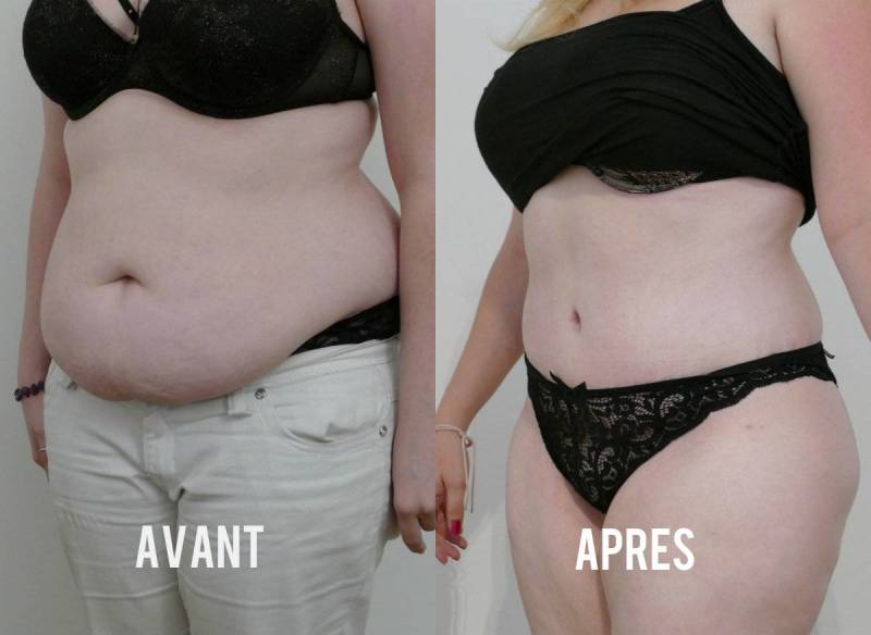 L’abdominoplastie à Bandol dans le Var 83